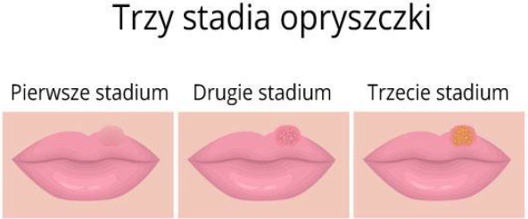 Herpotherm urządzenie do zwalczania opryszczki 1 szt.